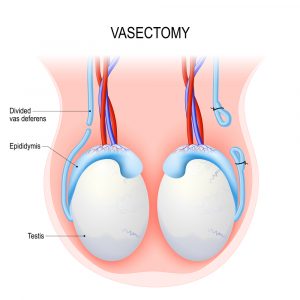 vasectomy diagram