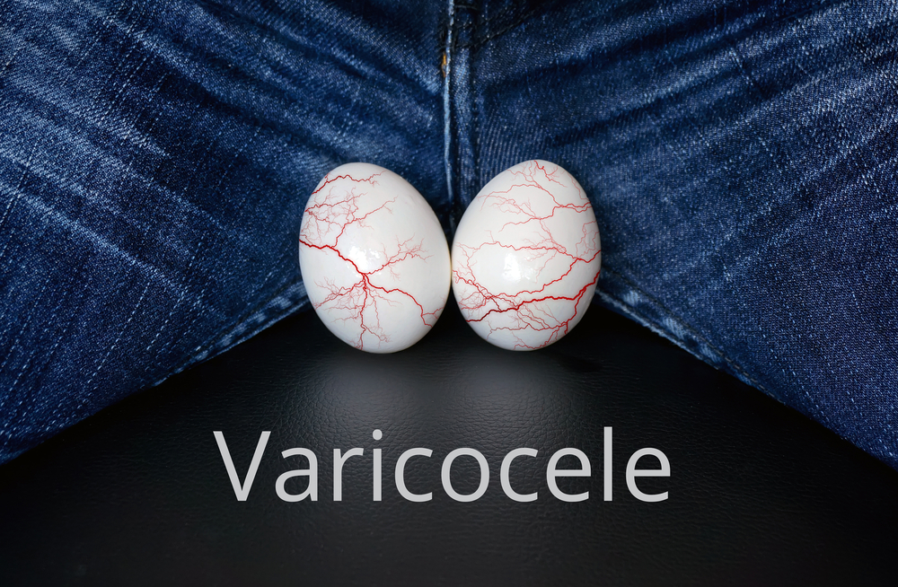 varicocele veins on eggs