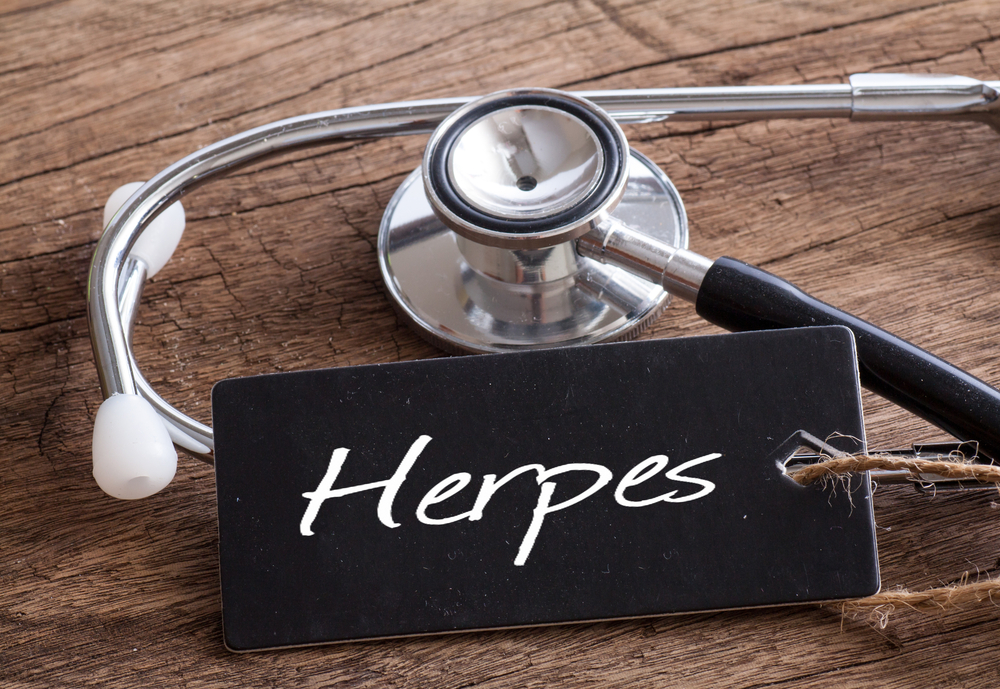 herpes and how to treat it