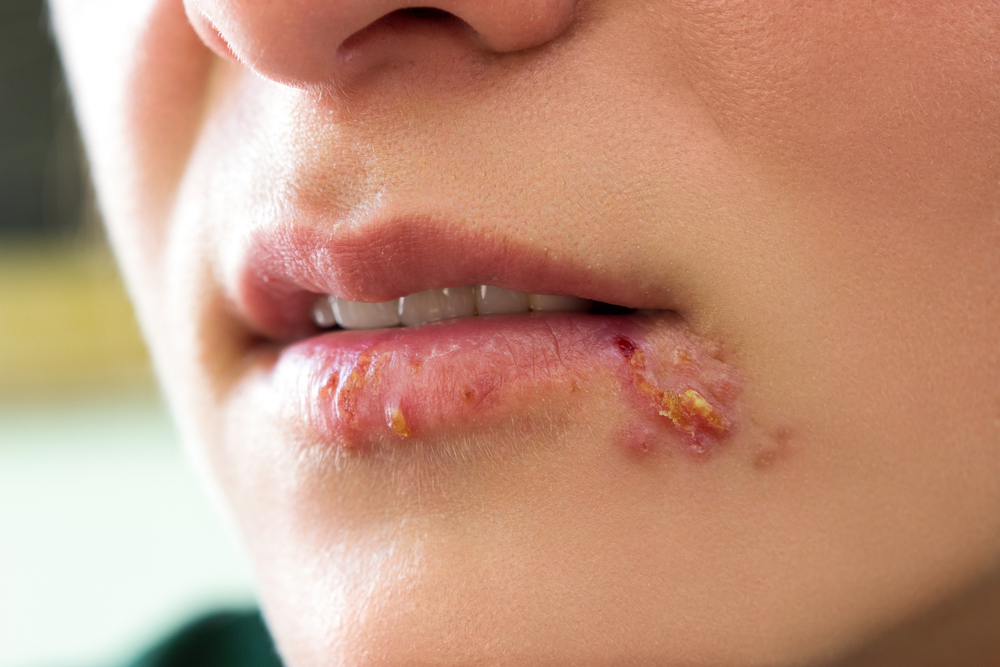 infected cold sore blisters
