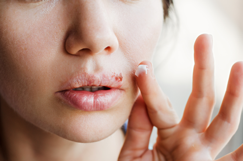 applying ointment to cold sore