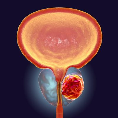 inflamed prostate