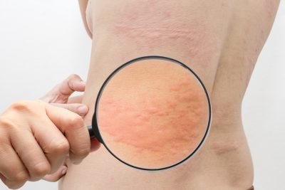 hives skin rash